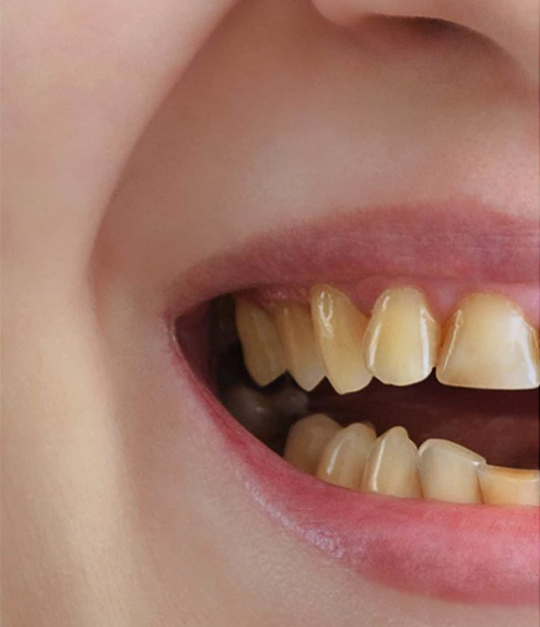 Smile Makeover before treatment