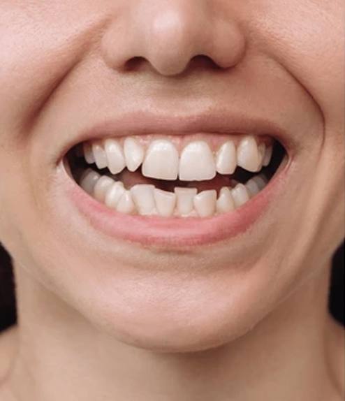 Invisalign before treatment
