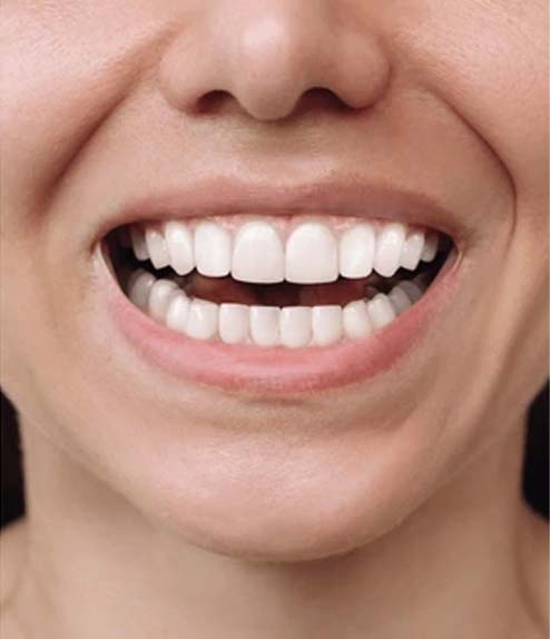Invisalign after treatment