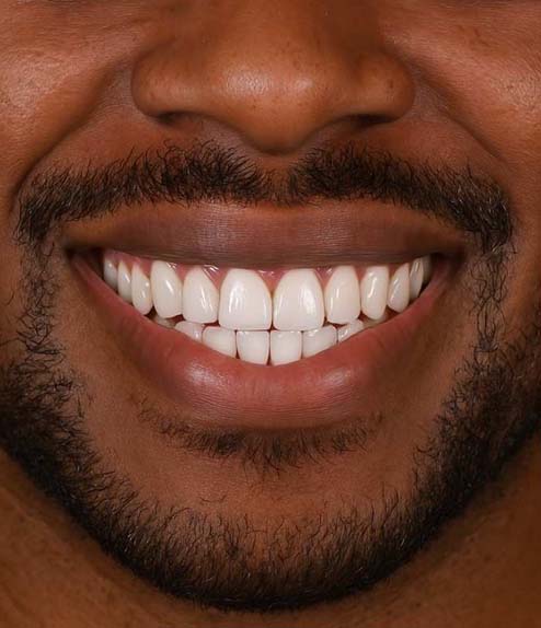 Smile Makeover after treatment