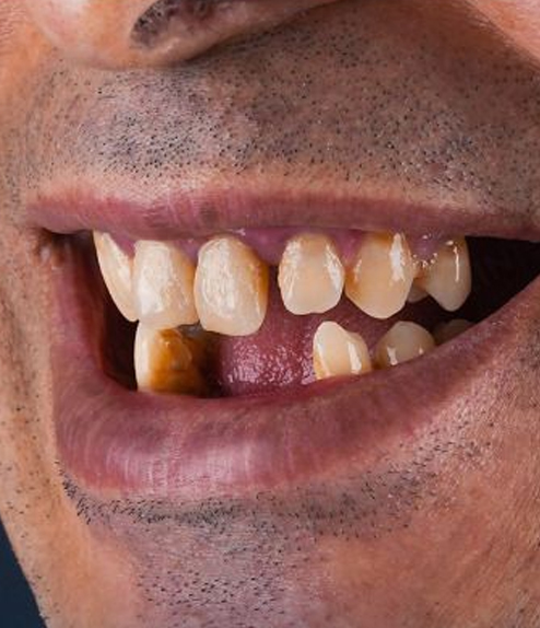Dental Implants before treatment