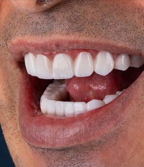 Dental Implants after treatment