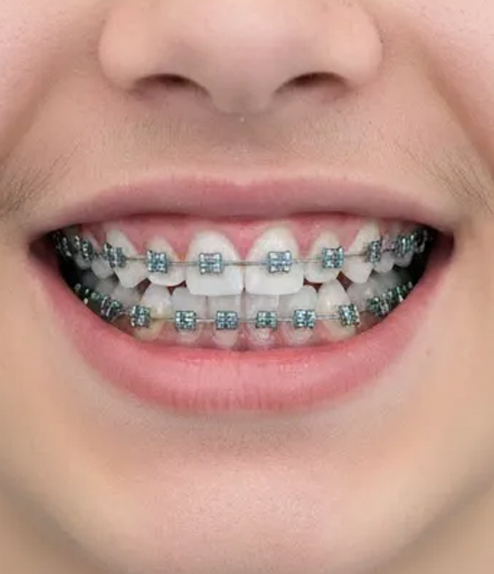 Invisalign before treatment