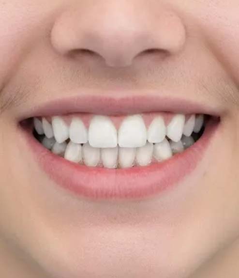 Invisalign after treatment