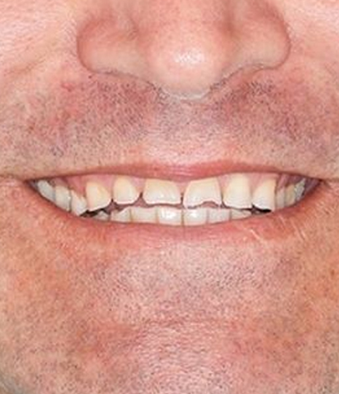 Veneers before treatment