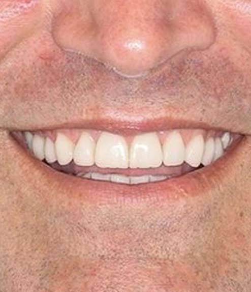 Veneers after treatment