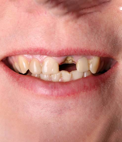 Full Mouth Restoration before treatment
