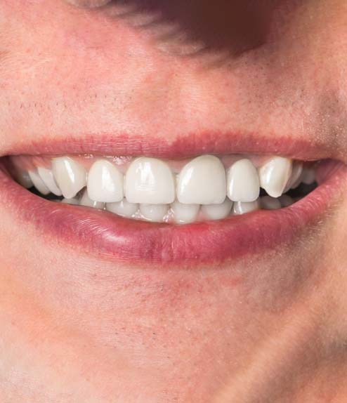 Full Mouth Restoration after treatment