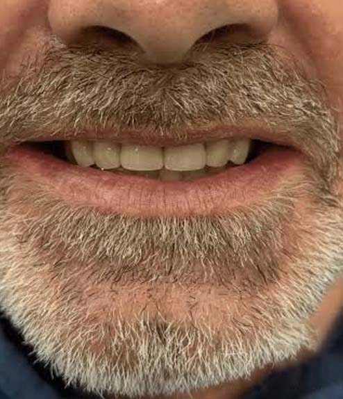 Dental Crown after treatment