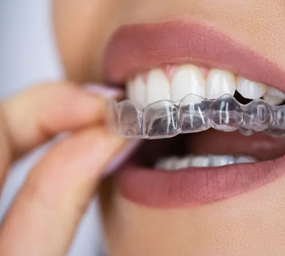Invisalign