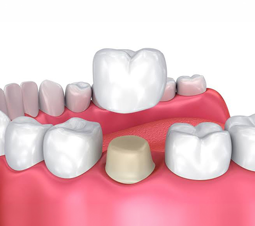 A dental crown is a custom-made cap that covers and protects a damaged, weak, or worn tooth. It restores the tooth's: