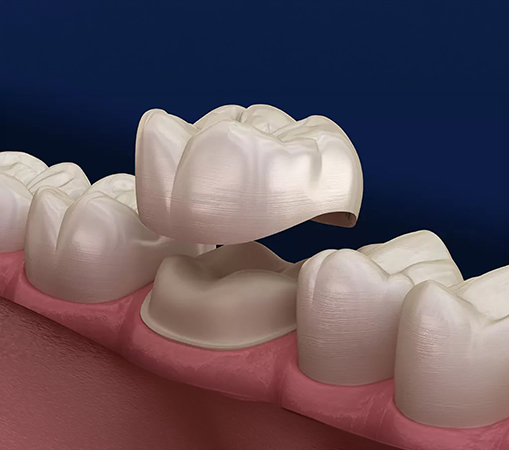 You may need a dental crown if you have: