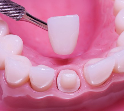 Tooth Preparation
