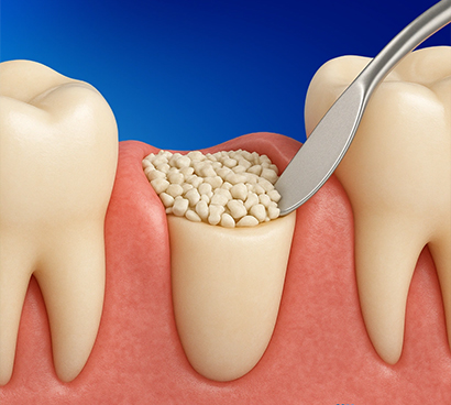 Tooth Preservation