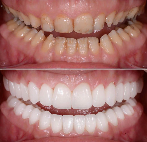 Full Mouth Restoration
