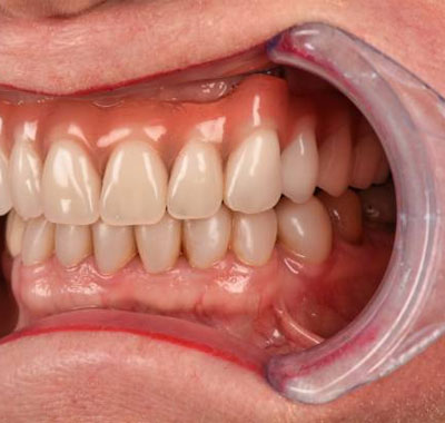 Our Full Mouth Restoration Process