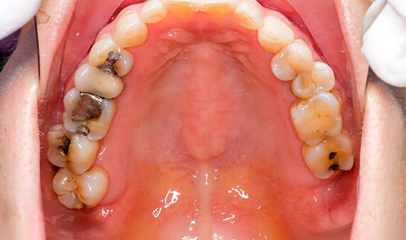 Fillings