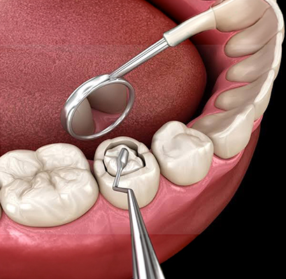 What Are Dental Fillings And Why Do You Actually Need One?
