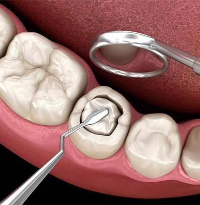 Composite Resin Fillings (Tooth-Coloured)