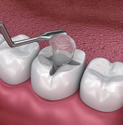 Glass Ionomer Fillings