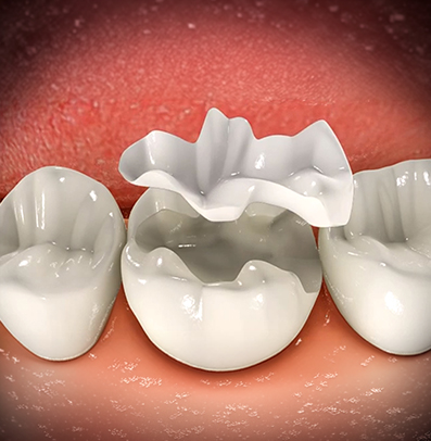 Ceramic / Porcelain Inlays & Onlays