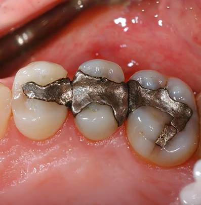 What About Amalgam (Silver) Fillings?