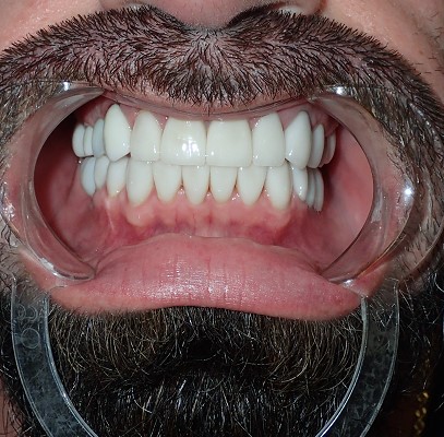 Smile Makeover after treatment
