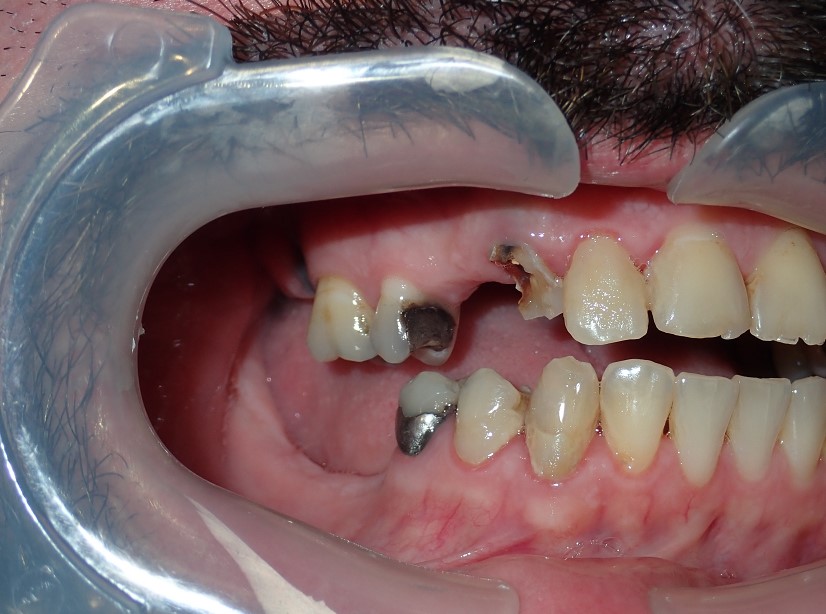 Smile Makeover before treatment