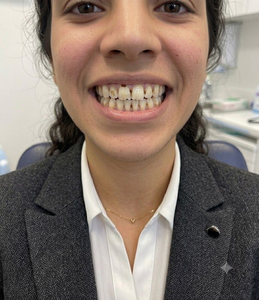 Smile Makeover before treatment