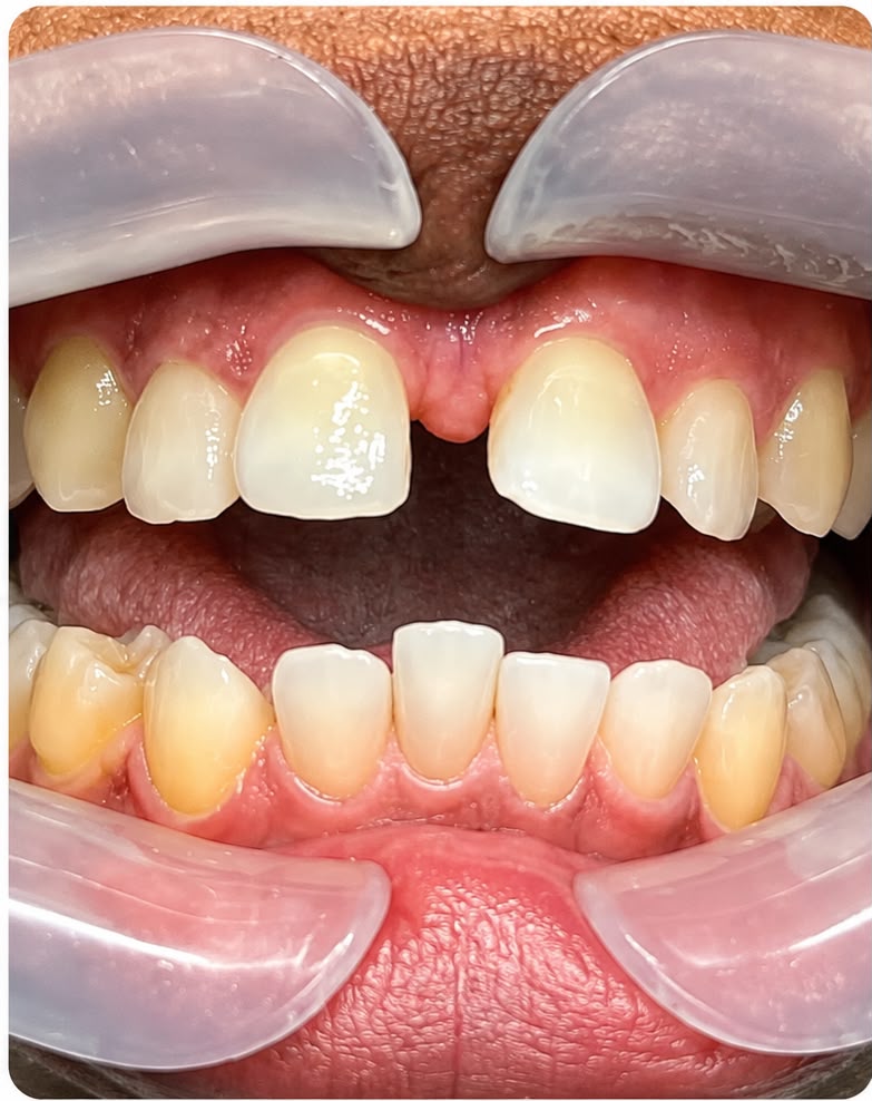 Invisalign before treatment