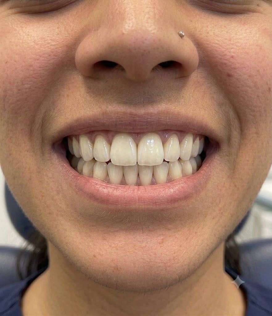 Veneers after treatment