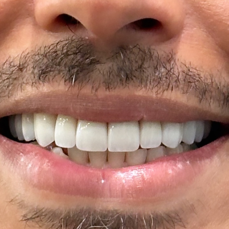 Full Mouth Restoration after treatment