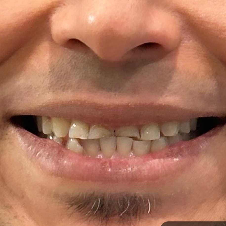 Full Mouth Restoration before treatment