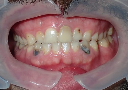 Dental Implants before treatment