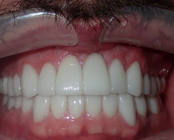Dental Implants after treatment