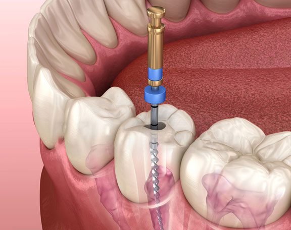 Root Canal Treatment
