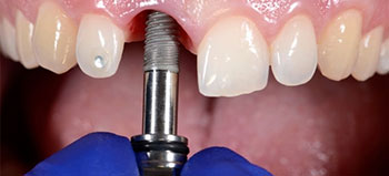 Dental Implants