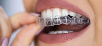 Invisalign