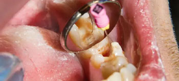 Root Canal Treatment