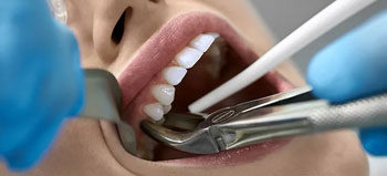 Tooth Removal