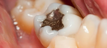 Fillings