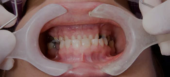 Full Mouth Restoration