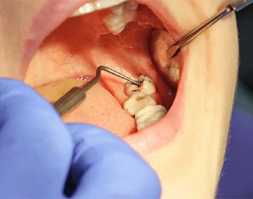 What Is Wisdom Tooth Removal?
