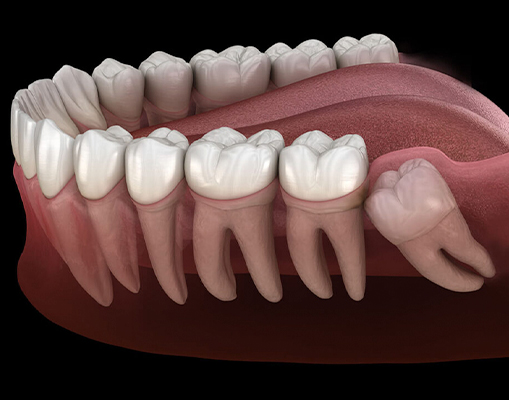 Why Wisdom Tooth Removal Is Important?