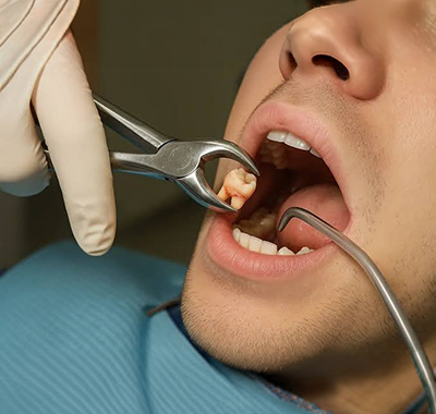 Our Wisdom Tooth Removal Process