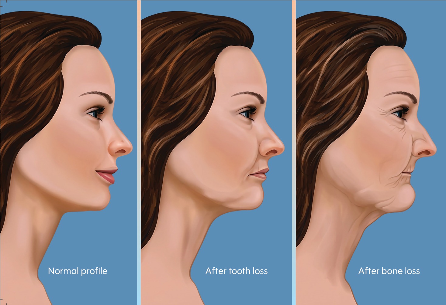 What Are Dental Implants?