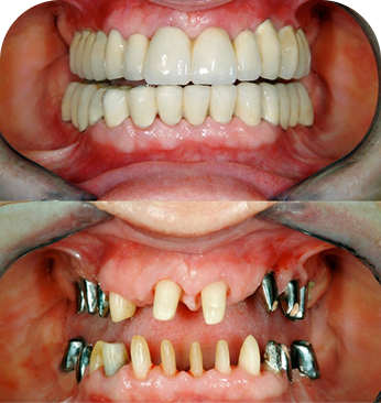 Full Mouth Implants (All-on-X)
