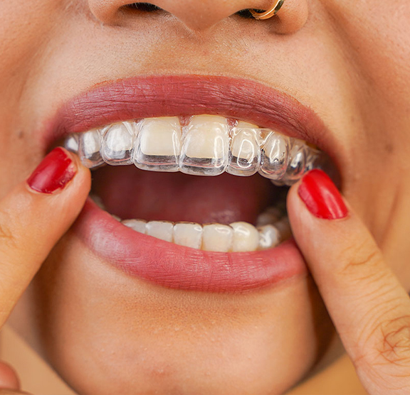 Signs You May Need Invisalign or