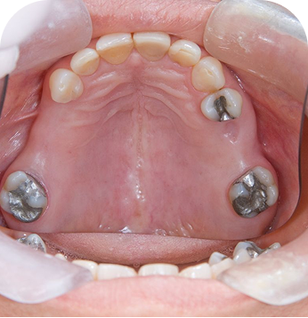 Implant-Supported Bridge