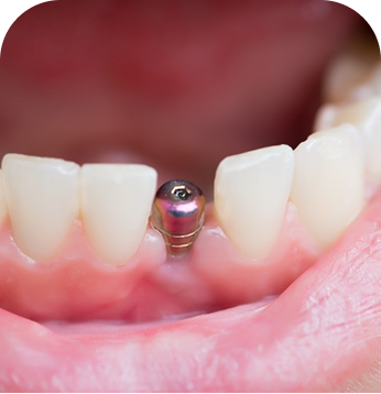 Single Tooth Implant